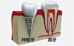 烟台种植牙需要满足的条件及要求