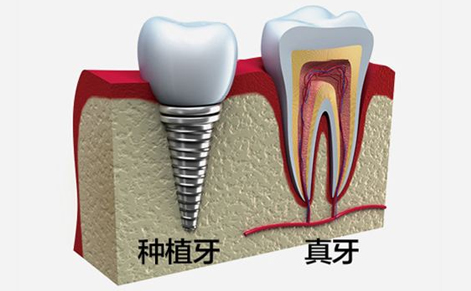 种植牙同传统义齿相比的优点
