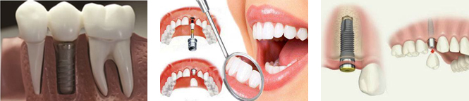 种植牙的过程你知道吗