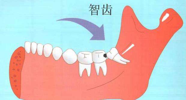 拔智齿后的注意事项