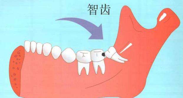 拔智齿后的注意事项