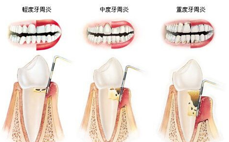 什么时候拔牙合适