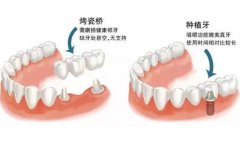 种植牙与烤瓷牙的区别