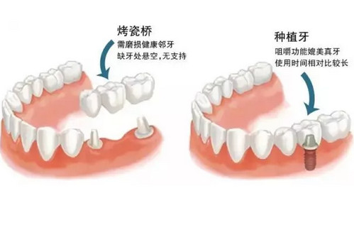 烟台种植牙与烤瓷牙两者各自的优缺点