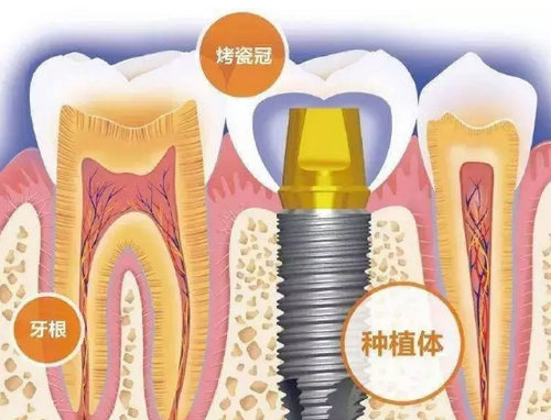 回馈父母，就从给他做烟台种植牙开始吧